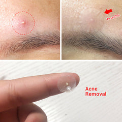 Tea Tree Daily Acne Stickers + Night acne Stickers Fade Blackhead Acne Remover